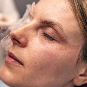 Plasma Fibroblast Course